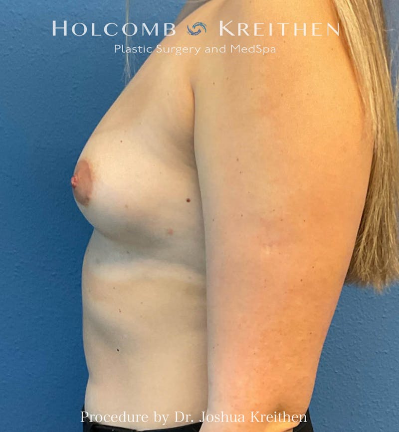 Motiva Breast Implants Before & After Gallery - Patient 298736 - Image 5
