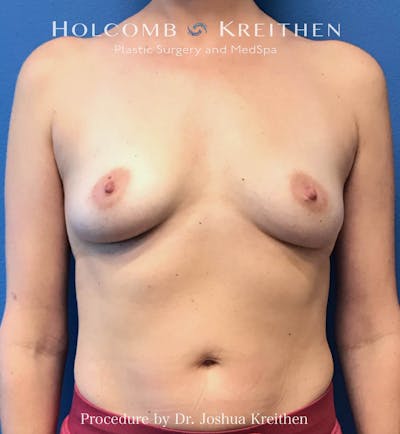 Motiva Breast Implants Before & After Gallery - Patient 225705 - Image 1