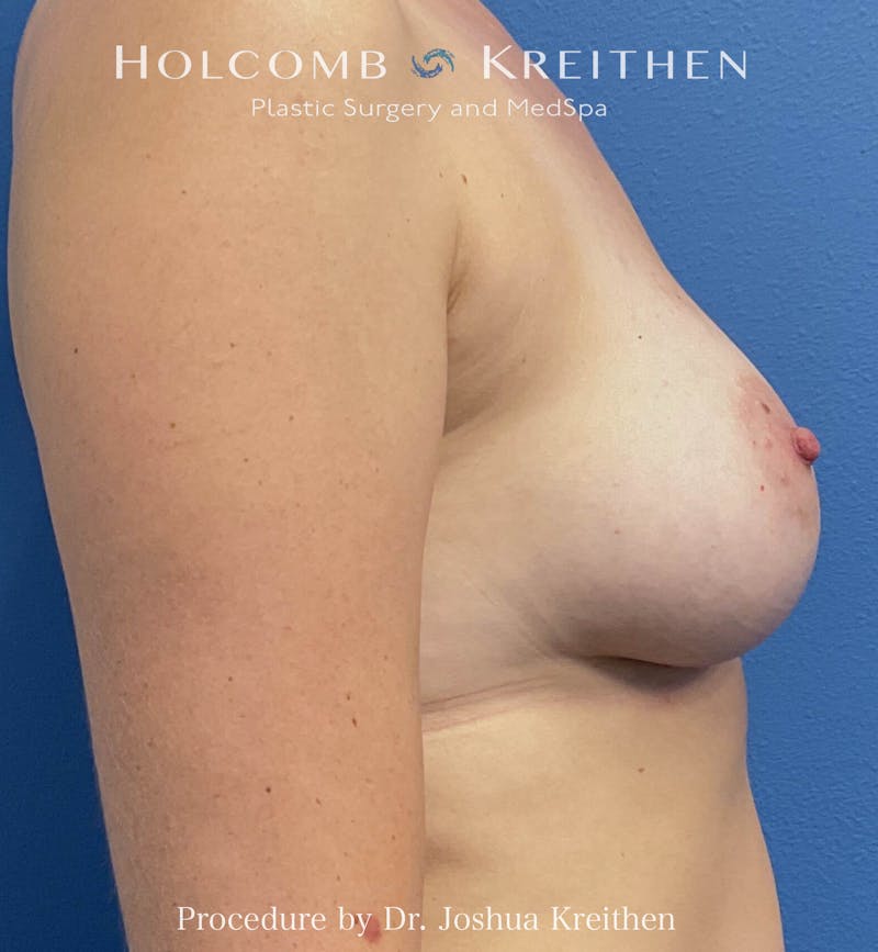 Motiva Breast Implants Before & After Gallery - Patient 225705 - Image 6