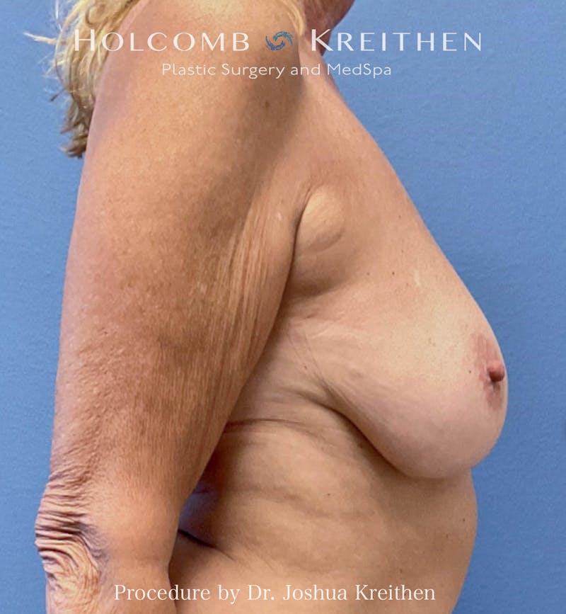 Motiva Breast Implants Before & After Gallery - Patient 293638 - Image 3
