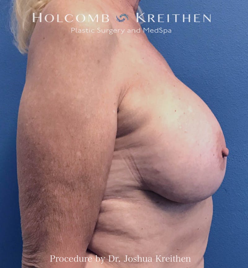 Motiva Breast Implants Before & After Gallery - Patient 293638 - Image 4