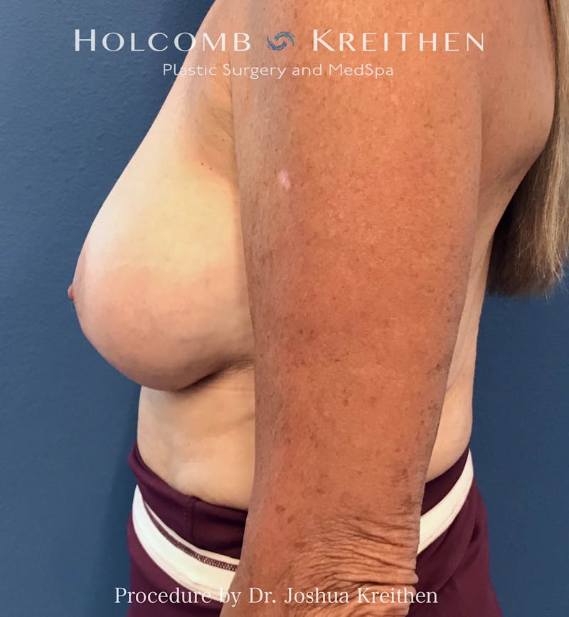 Motiva Breast Implants Before & After Gallery - Patient 229488 - Image 4