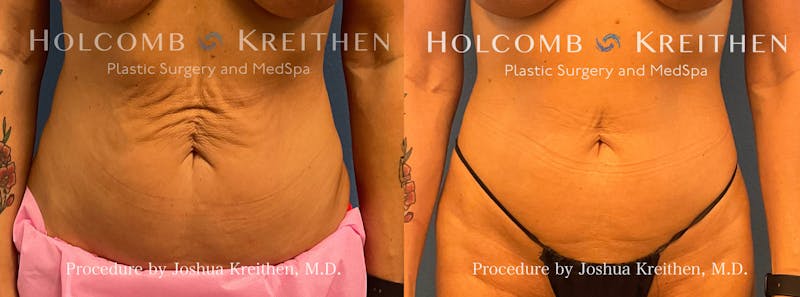 Mini Abdominoplasty Before & After Gallery - Patient 496708 - Image 1