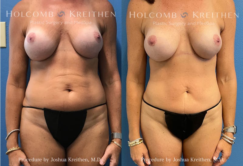 Mini Abdominoplasty Before & After Gallery - Patient 406402 - Image 1