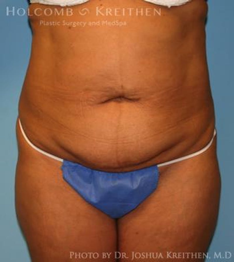 Mini Abdominoplasty Before & After Gallery - Patient 355848 - Image 1