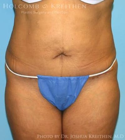 Mini Abdominoplasty Before & After Gallery - Patient 355848 - Image 2