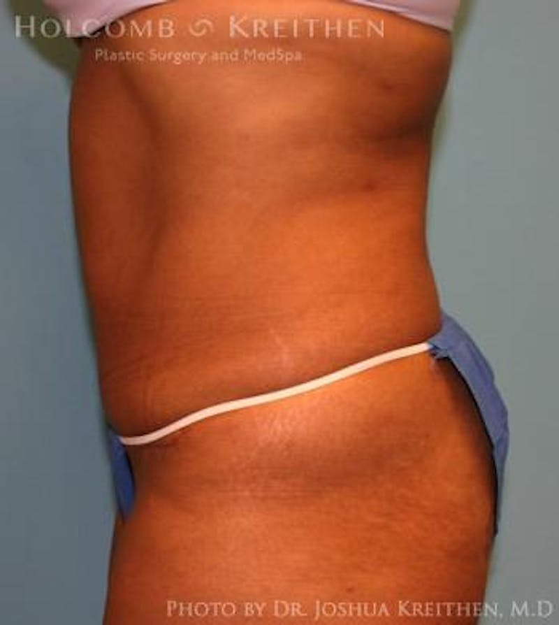 Mini Abdominoplasty Before & After Gallery - Patient 355848 - Image 4
