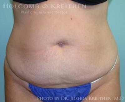Mini Abdominoplasty Before & After Gallery - Patient 272475 - Image 1