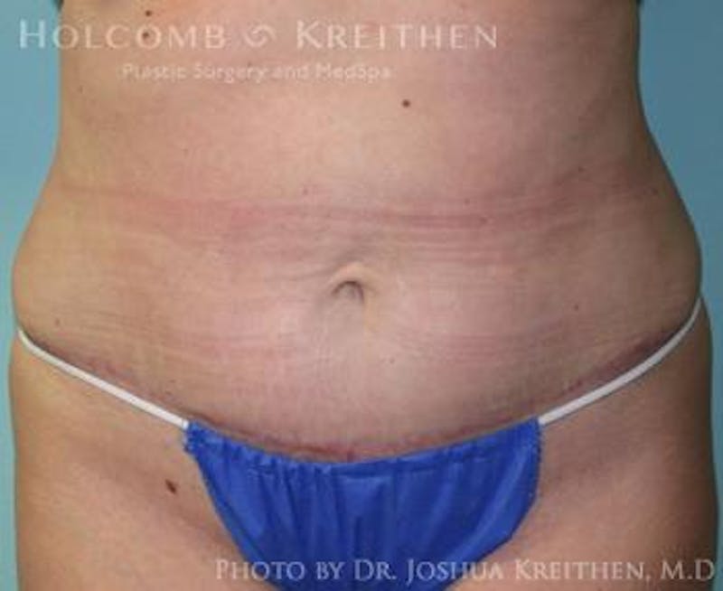Mini Abdominoplasty Before & After Gallery - Patient 272475 - Image 2
