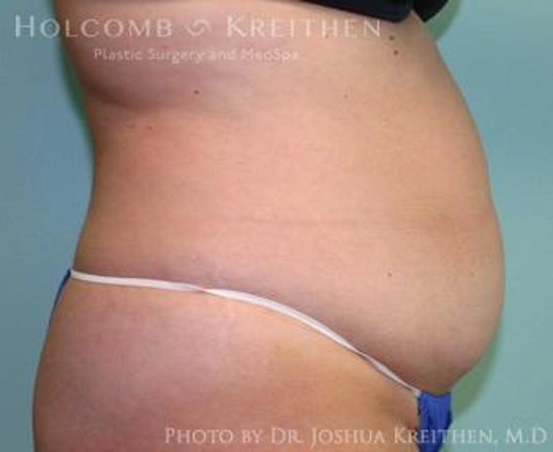 Mini Abdominoplasty Before & After Gallery - Patient 272475 - Image 3