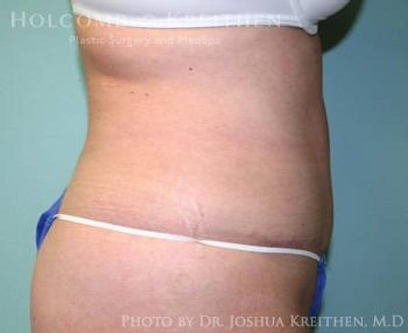 Mini Abdominoplasty Before & After Gallery - Patient 272475 - Image 4