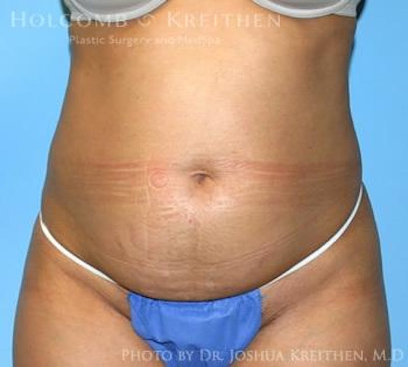 Mini Abdominoplasty Before & After Gallery - Patient 411793 - Image 1