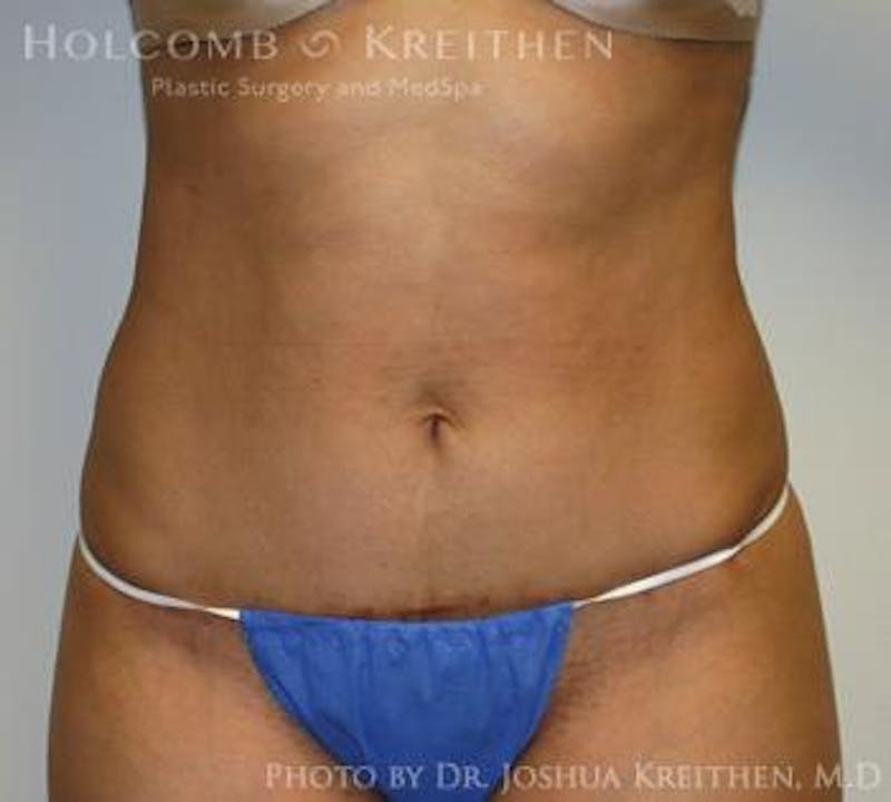 Mini Abdominoplasty Before & After Gallery - Patient 411793 - Image 2