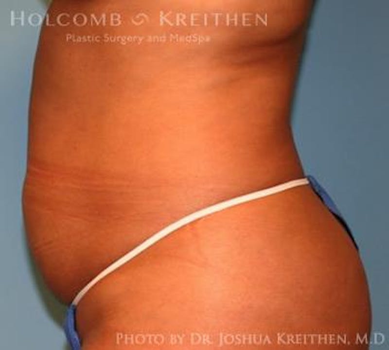 Mini Abdominoplasty Before & After Gallery - Patient 411793 - Image 3