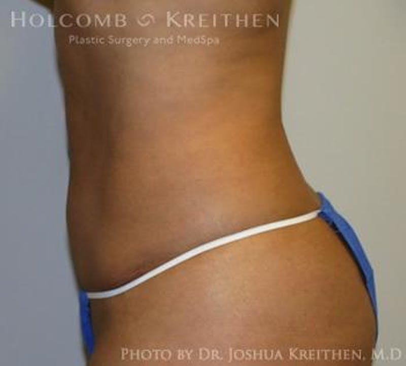 Mini Abdominoplasty Before & After Gallery - Patient 411793 - Image 4