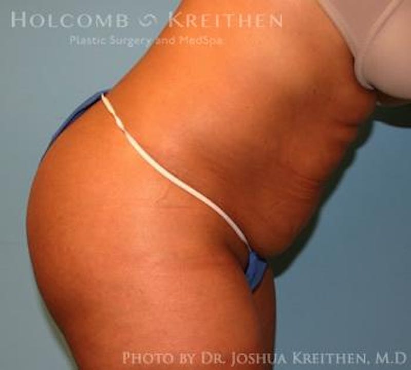 Mini Abdominoplasty Before & After Gallery - Patient 411793 - Image 5