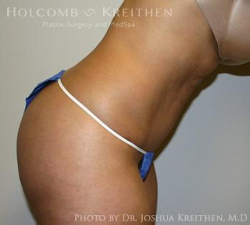 Mini Abdominoplasty Before & After Gallery - Patient 411793 - Image 6