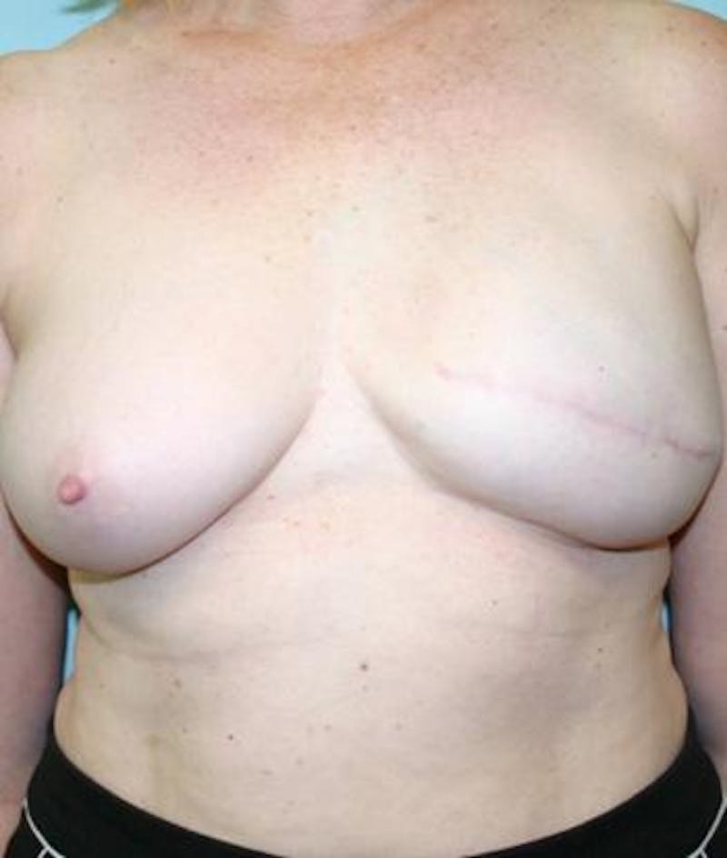 Breast Reconstruction Before & After Gallery - Patient 271846 - Image 2