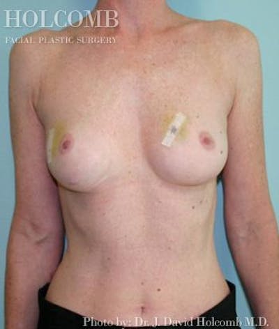 Breast Reconstruction Before & After Gallery - Patient 169068 - Image 1