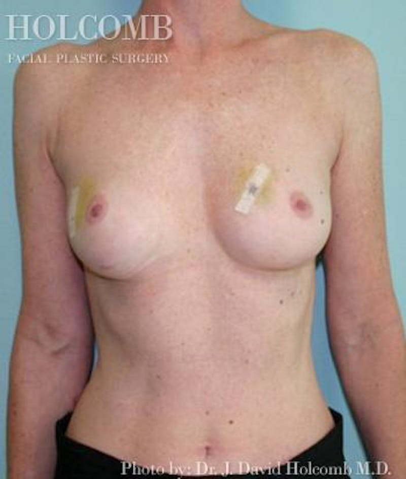 Breast Reconstruction Before & After Gallery - Patient 169068 - Image 1
