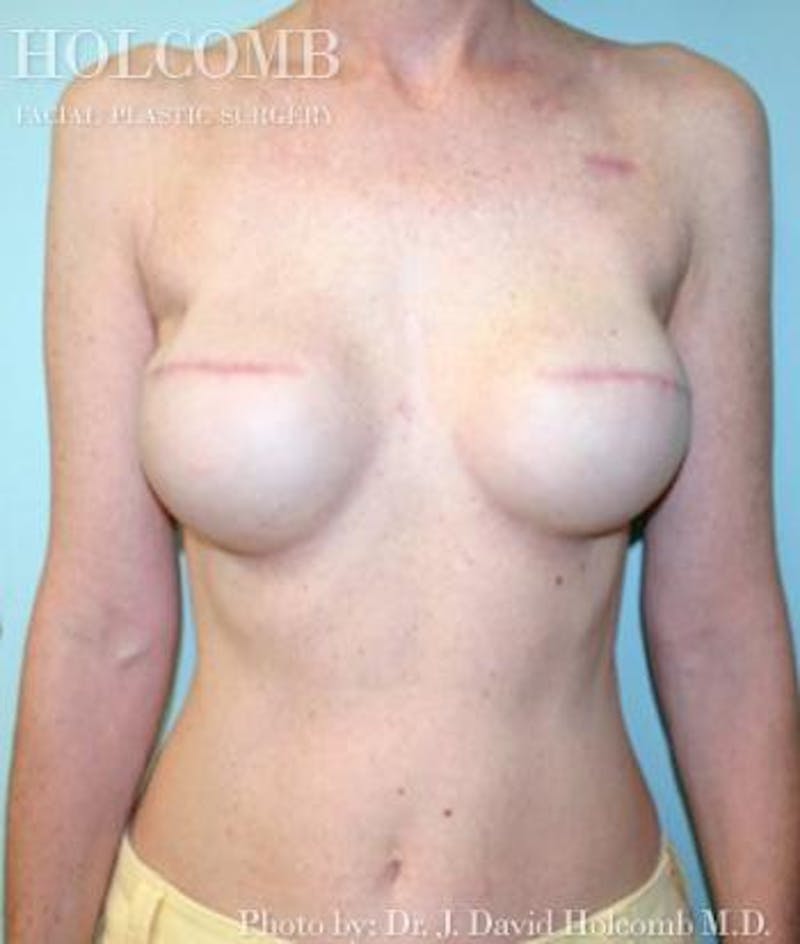 Breast Reconstruction Before & After Gallery - Patient 169068 - Image 2