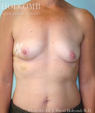 Breast Reconstruction Before & After Gallery - Patient 384347 - Image 1