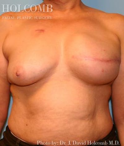 Breast Reconstruction Before & After Gallery - Patient 389532 - Image 2