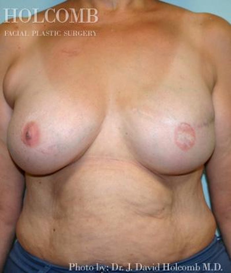Breast Reconstruction Before & After Gallery - Patient 389532 - Image 4
