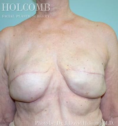 Breast Reconstruction Before & After Gallery - Patient 311206 - Image 2