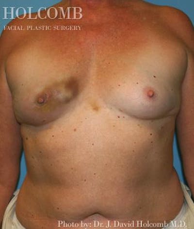 Breast Reconstruction Before & After Gallery - Patient 317719 - Image 1