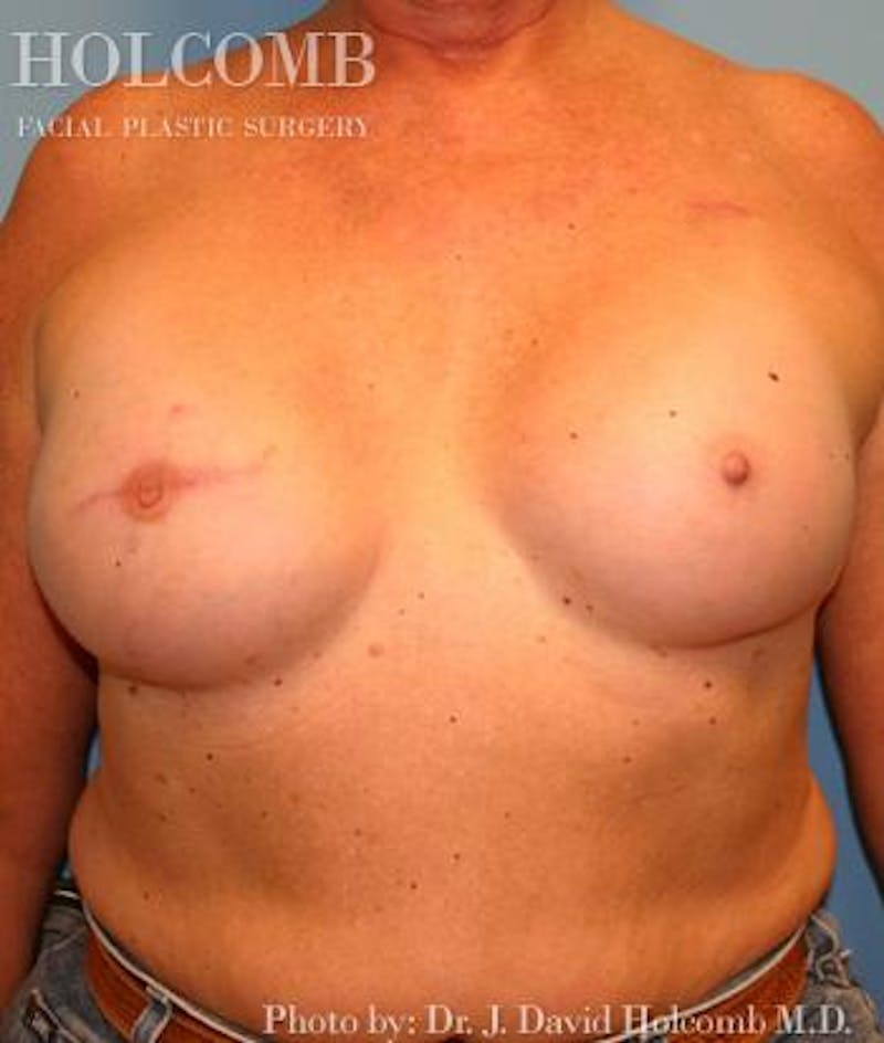 Breast Reconstruction Before & After Gallery - Patient 317719 - Image 2