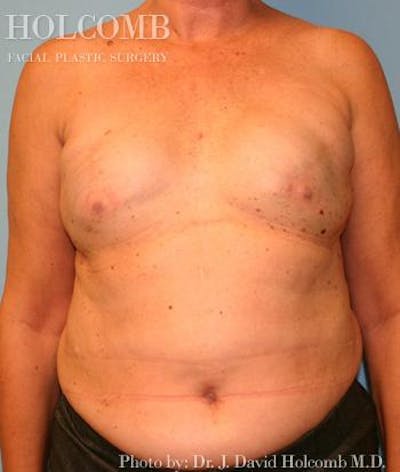 Breast Reconstruction Before & After Gallery - Patient 508189 - Image 1