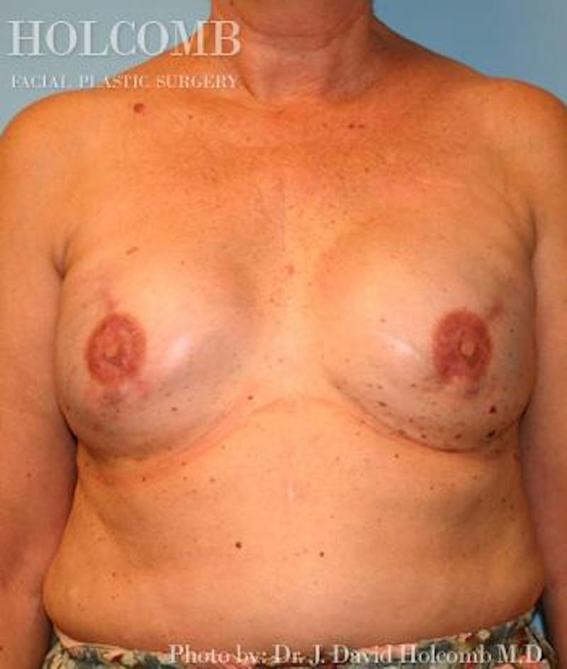 Breast Reconstruction Before & After Gallery - Patient 508189 - Image 2