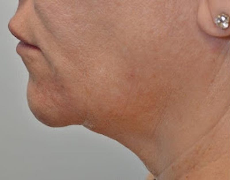 FaceTite Before & After Gallery - Patient 304749 - Image 1