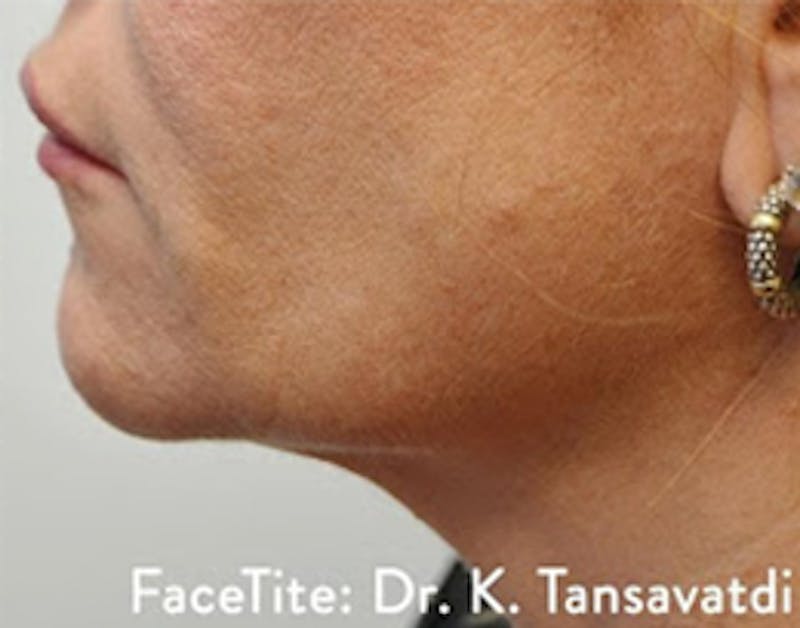 FaceTite Before & After Gallery - Patient 304749 - Image 2