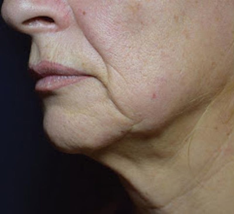 FaceTite Before & After Gallery - Patient 373720 - Image 1