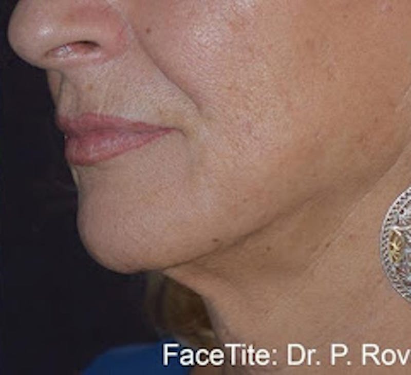 FaceTite Before & After Gallery - Patient 373720 - Image 2