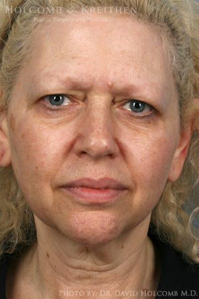 Energy Assisted Face/Neck Lift Before & After Gallery - Patient 213269 - Image 1