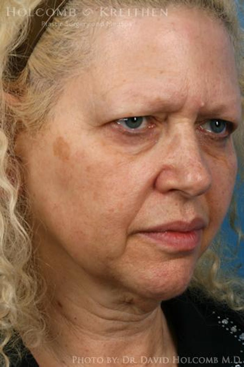Energy Assisted Face/Neck Lift Before & After Gallery - Patient 213269 - Image 3