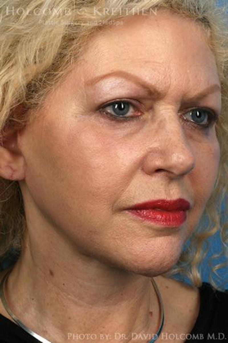 Energy Assisted Face/Neck Lift Before & After Gallery - Patient 213269 - Image 4
