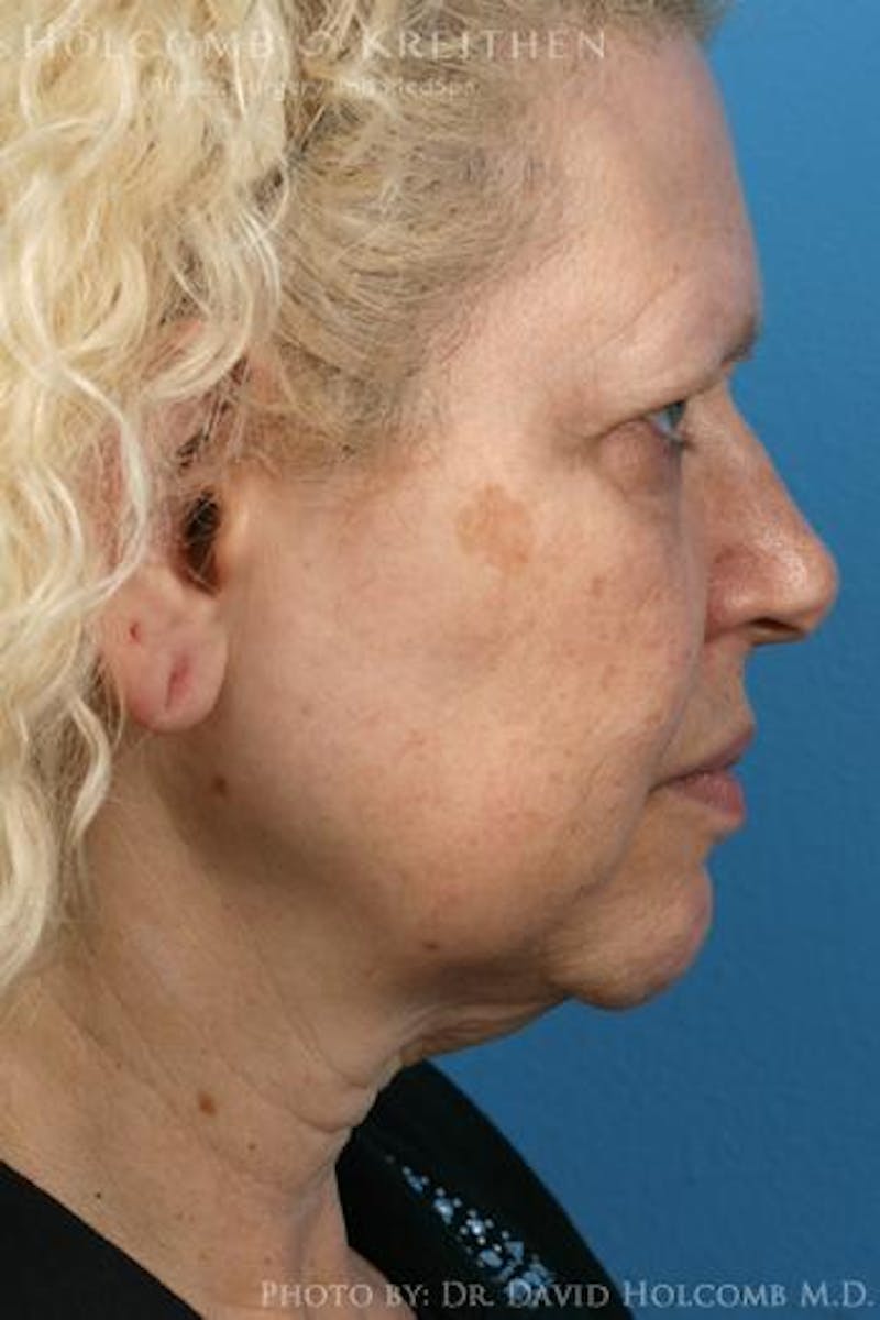 Energy Assisted Face/Neck Lift Before & After Gallery - Patient 213269 - Image 5