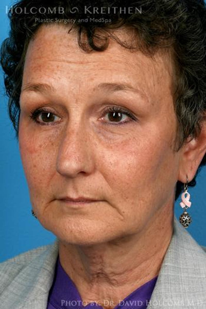 Neck Contouring Before & After Gallery - Patient 244000 - Image 3