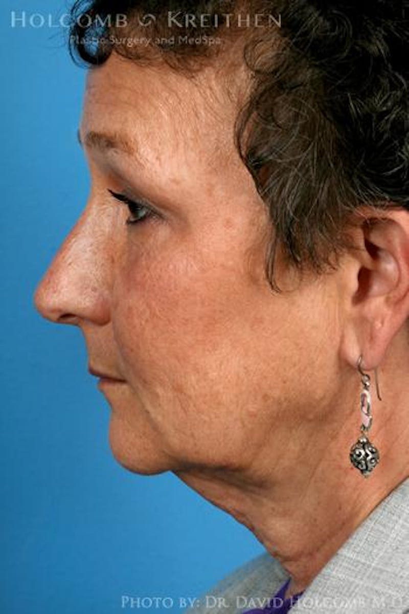 Neck Contouring Before & After Gallery - Patient 244000 - Image 5