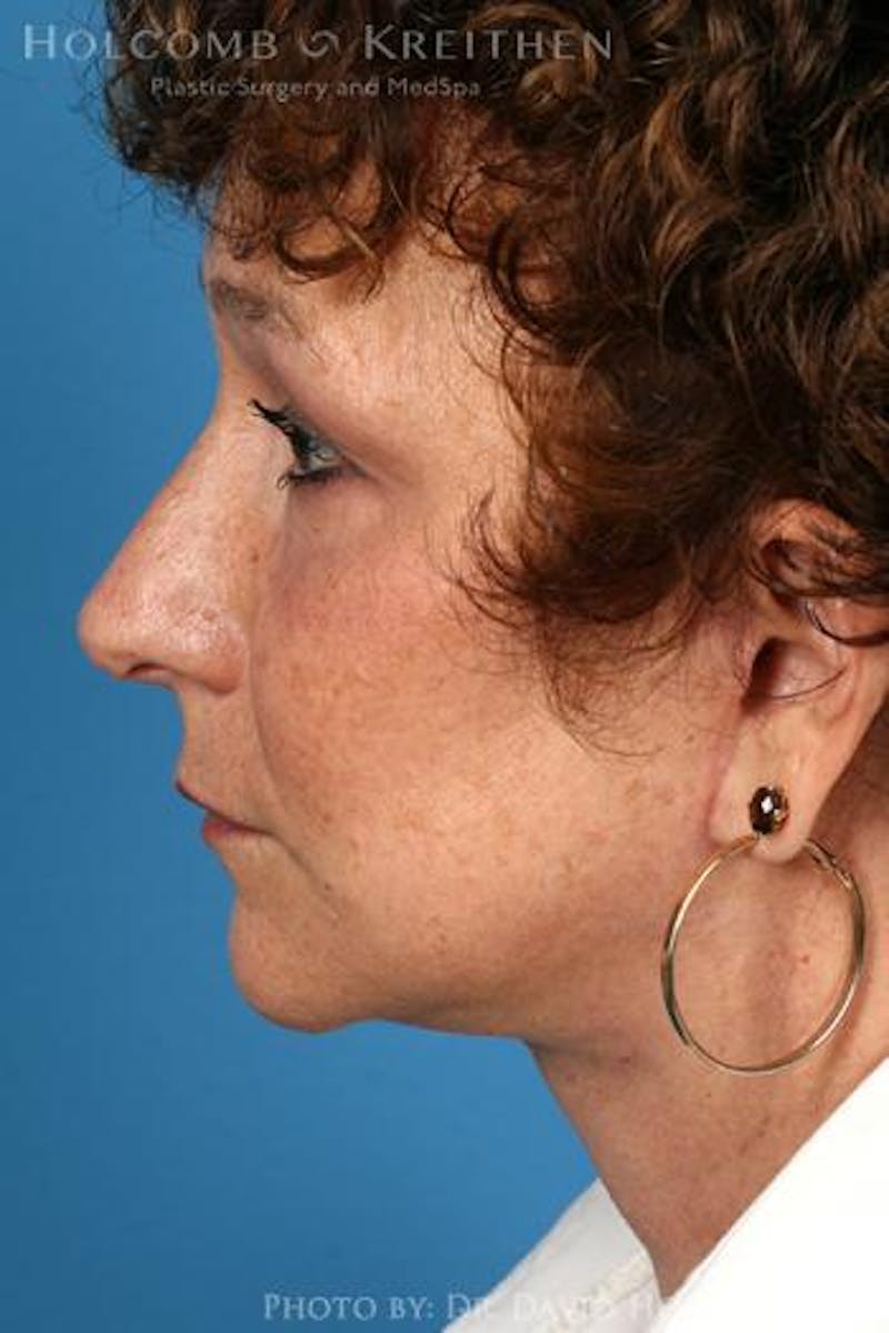 Neck Contouring Before & After Gallery - Patient 244000 - Image 6