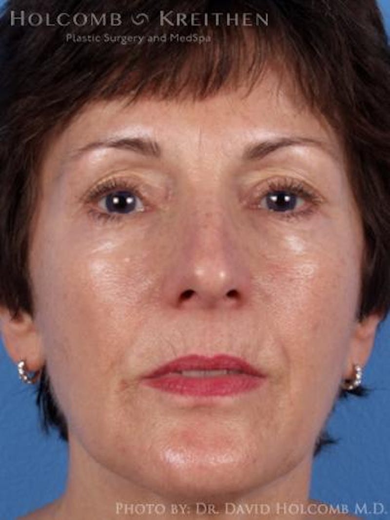Neck Contouring Before & After Gallery - Patient 873802 - Image 1