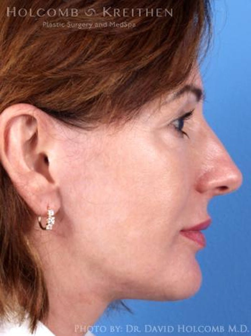 Neck Contouring Before & After Gallery - Patient 873802 - Image 6