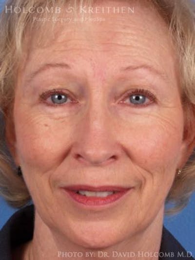 Energy Assisted Face/Neck Lift Before & After Gallery - Patient 367029 - Image 1