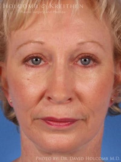 Energy Assisted Face/Neck Lift Before & After Gallery - Patient 367029 - Image 2