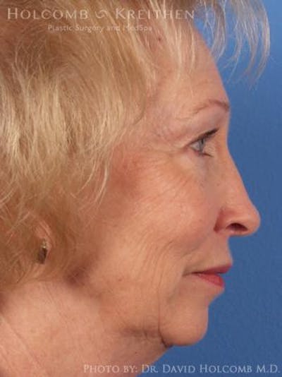 Neck Contouring Before & After Gallery - Patient 256796 - Image 1