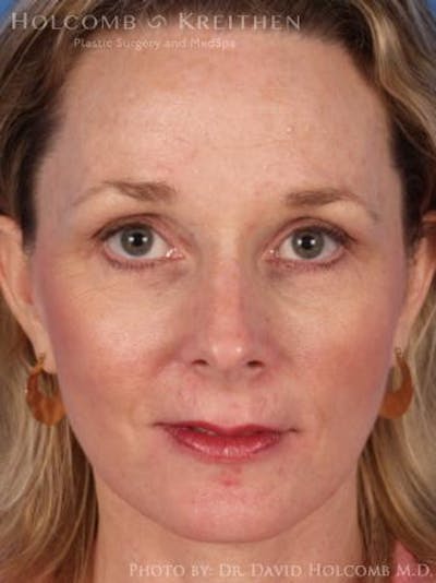 Energy Assisted Face/Neck Lift Before & After Gallery - Patient 282061 - Image 2